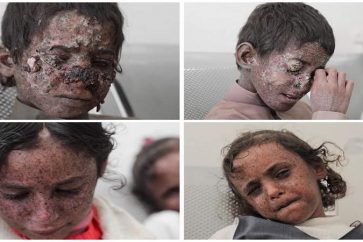 4 enfants yéménites atteints du cancer de la peau suite aux missiles saoudiens largués contre leur village.