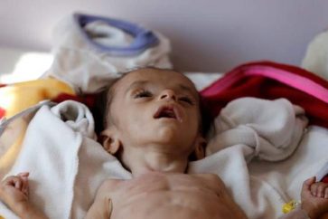 Une majorité d'enfants yéménites souffrent de malnutrition