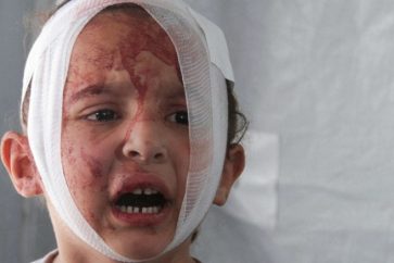 Un enfant Gazaoui blessé suite aux bombardements israéliens contre Gaza